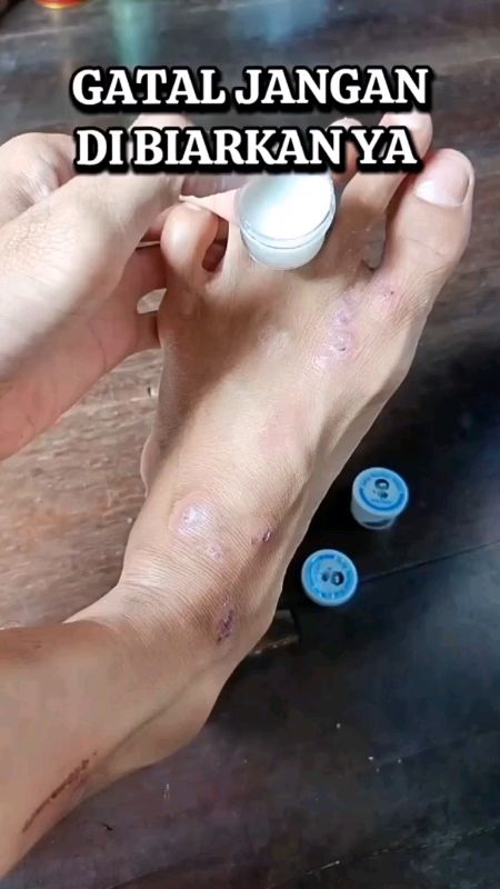salep obat gatal#salepgatalpalingampuh #salepkulit #kualitasterjamin #hargaterjangkau #berkahshopee #diskonshopee