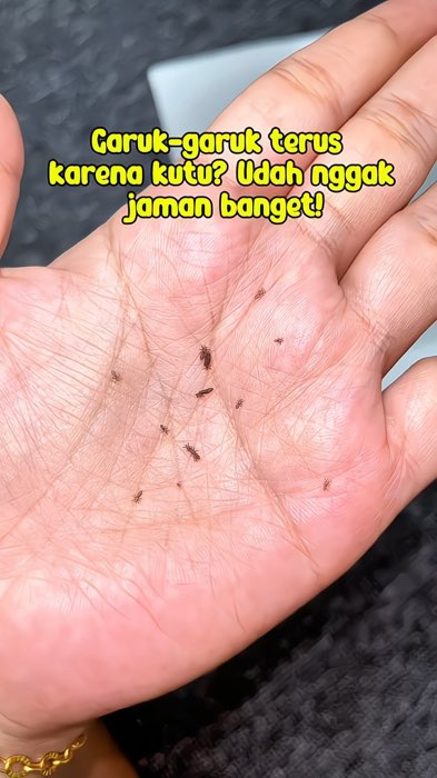 Sering garuk kepala tanpa sadar? 😭 Apalagi kalau lagi di depan orang… auto nggak pede 🤪  Bisa jadi itu karena kutu rambut yang belum tuntas!#modegas