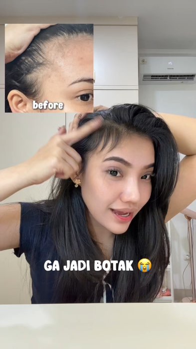 rambut ku berhasil numbuh lagi! #DiskonRacunShopee #shopeevideo #ShopeeReview #guncang55 #hairtonic #haircare #hairtonicrambutrontok #penumbuhrambut