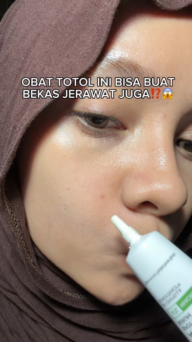 KANNN, ini yg aku mau jerawad + bekasnya hempaz
