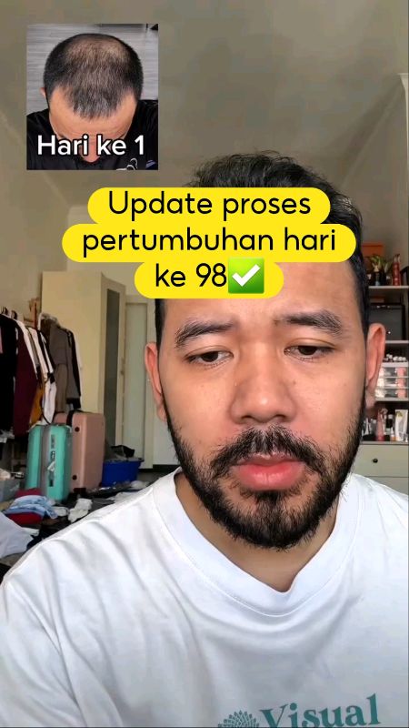 Update proses pertumbuhan hari ke 98✅️#syms #rosemaryoil #biotin ##minoxidil #penumbuhrambut #cegahbotak