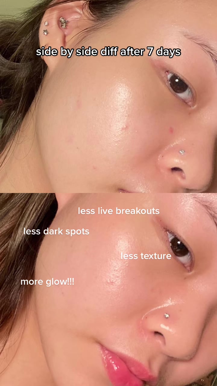 saya mulai menjadi cosrx girlie semuanya telah bekerja dengan baik untuk saya sejauh ini lihat saya coba / tinjau toner pengelupasan kimia aha bha ini selama 7 hari .. hasilnya berbicara sendiri #reannetries #beauty #chemicalexfoliation #cosrx #co...